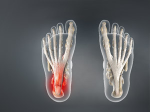 Plantar Fasciitis